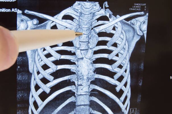 Osteocondroza coloanei vertebrale toracice: semne, simptome și tratament - Hondrostrong