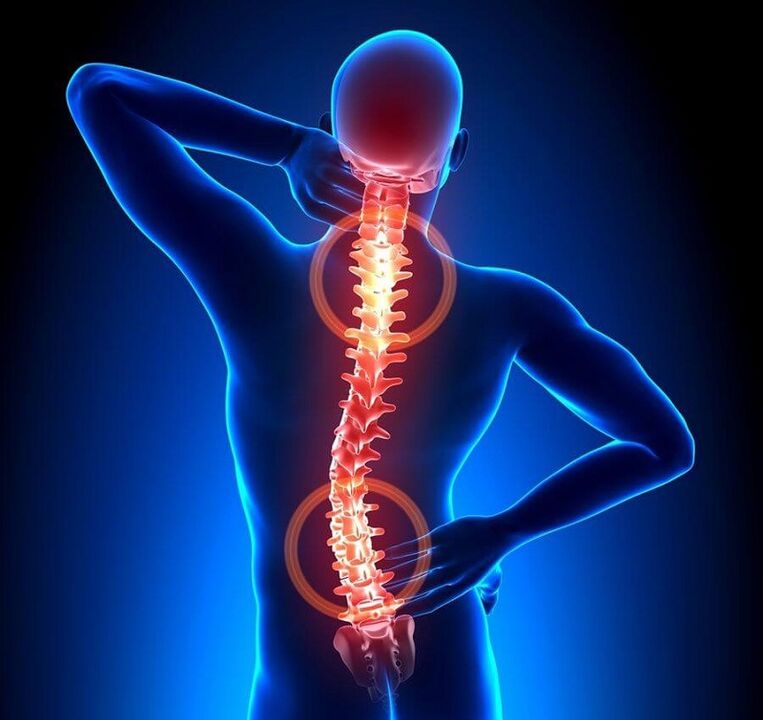 osteocondroza coloanei vertebrale ca cauză a durerilor de spate