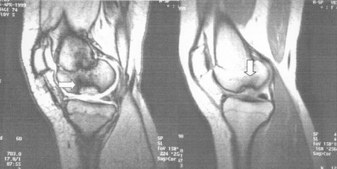 radiografia de osteocondroză disecă în articulația genunchiului