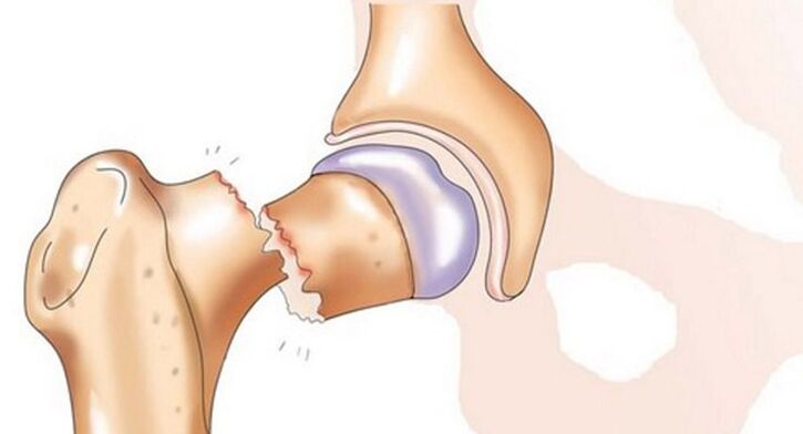 O fractură de col femural este însoțită de dureri severe la nivelul articulației șoldului